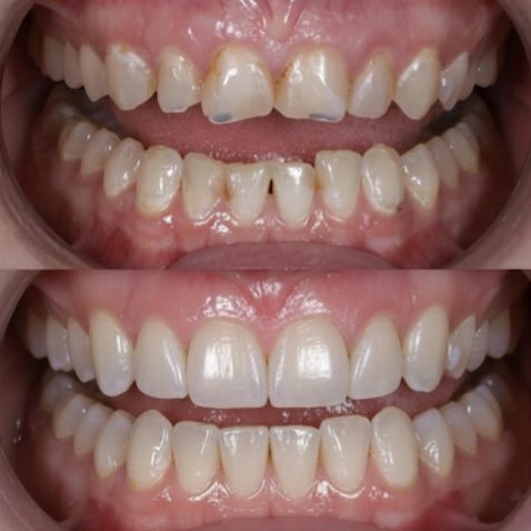 تبييض اسنان