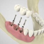 ما هي زراعة الأسنان؟ (Dental Implants)