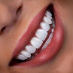 ما هو فينير الأسنان؟